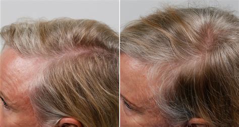 does hairmax really work|Hairmax® .